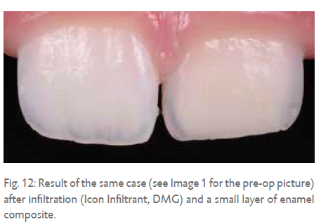 Fig. 12: Result of the same case (see Image 1 for the pre-op picture) after infiltration (Icon Infiltrant, DMG) and a small layer of enamel composite.
